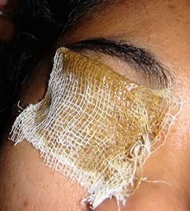 Bidalak:- This is where a glue of herbs is connected over the two eyes, and secured with a cotton bandage.
                        This animates the blood stream around the eyes, and opens the tear channels. It's an incredible method for dry and irritated eyes, delicate eyes in the sun, and for diminishing dark circles under the eyes.